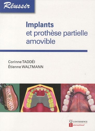 Implants et prothèse partielle amovible