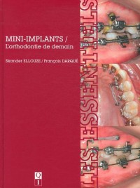 Mini-implants : L'orthodontie de demain