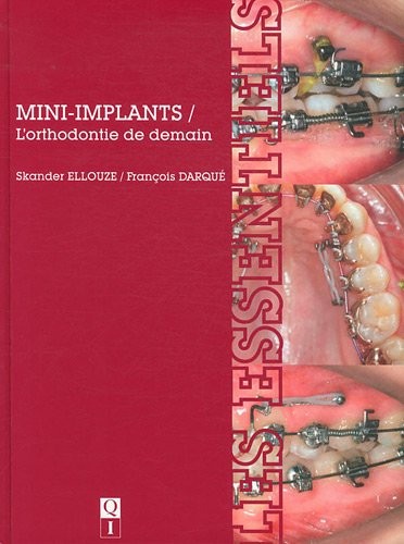 Mini-implants : L'orthodontie de demain
