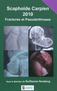 Scaphoïde carpien : Fractures et pseudoarthroses