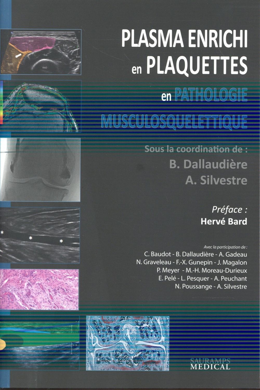 Plasma enrichi en plaquettes en pathologie musculosquelettique