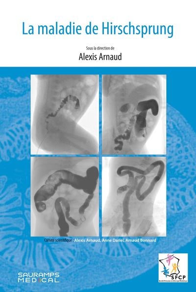 La maladie de Hirschsprung