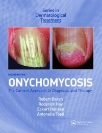 Onychomycosis: The Current Approach to Diagnosis and Therapy