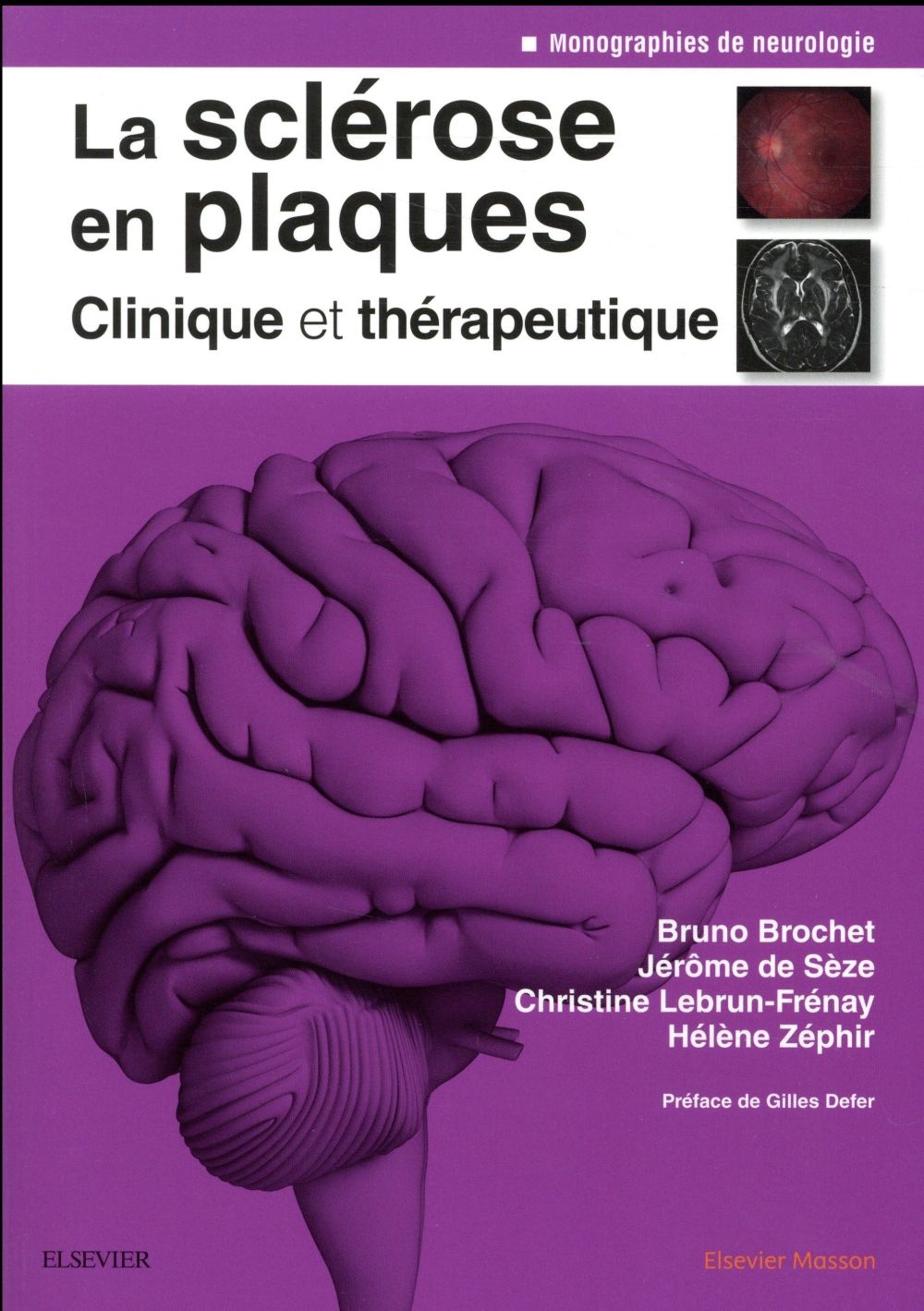 La sclérose en plaques - Clinique et thérapeutique