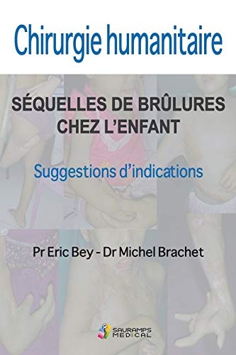 CHIRURGIE HUMANITAIRE. SEQUELLES DE BRULURES CHEZ L ENFANT