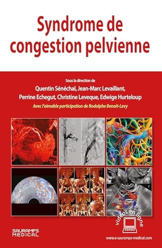 Syndrome de congestion pelvienne