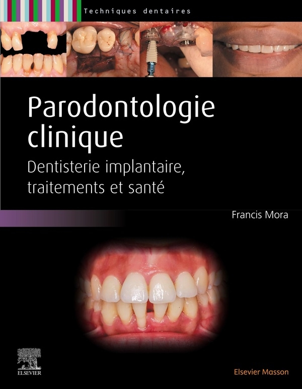 Parodontologie: Maladie Parodontale, Décision Thérapeutique, Traitements, Implantologie