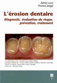 L'érosion dentaire : Diagnostic, évaluation du risque, prévention, traitement