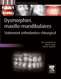 Dysmorphies maxillo-mandibulaires: Traitement orthodontico-chirurgical