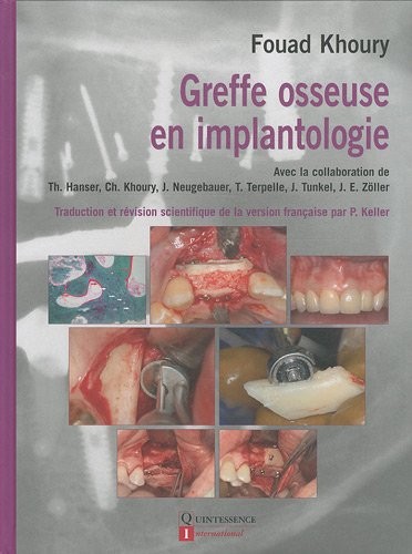 Greffe osseuse en implantologie