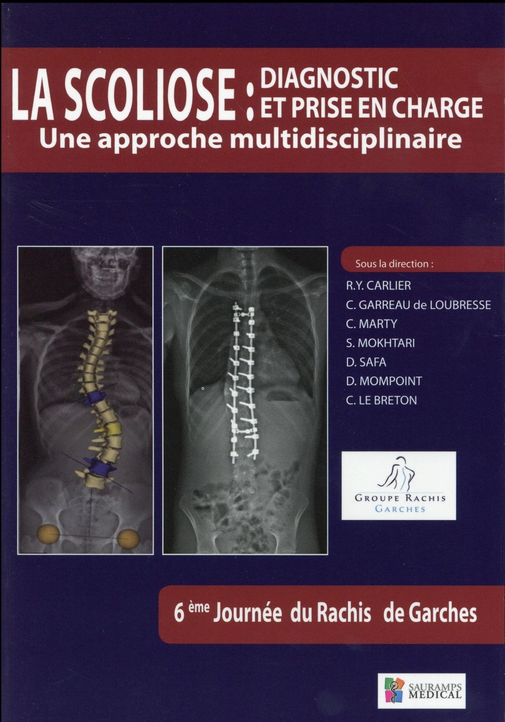 La scoliose : diagnostic et prise en charge : Une approche multidisciplinaire